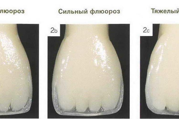 Эндемический флюороз: профилактика и лечение